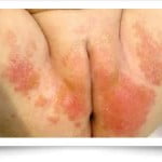 dermatitisdelpañal2