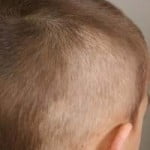 alopecia3