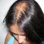 alopecia4