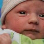 dermatitis seborreica1