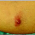 Enfermedad por arañazo de gato3