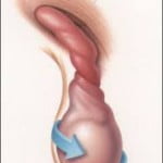 torsiontesticular2