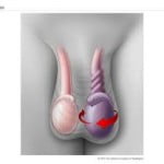 torsiontesticular3