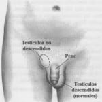 criptorquidia3