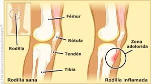 dolor rodillas3