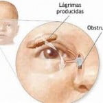 lagrimal3