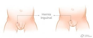 hernia1