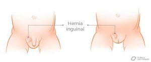 hernia1