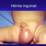 hernia6