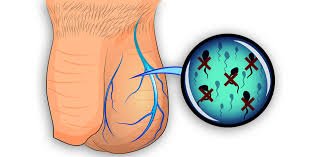 varicocele2