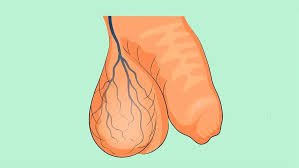 varicocele3