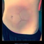 abdomen3